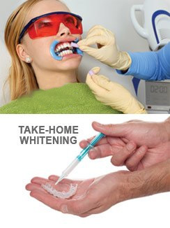 Teeth Whitening Options.